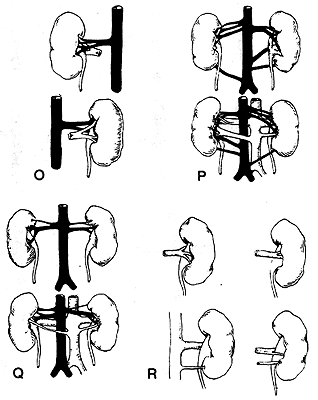 Image of variations in renal vessels