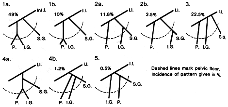 Image of variation in origin of the parietal branches of internal iliac artery