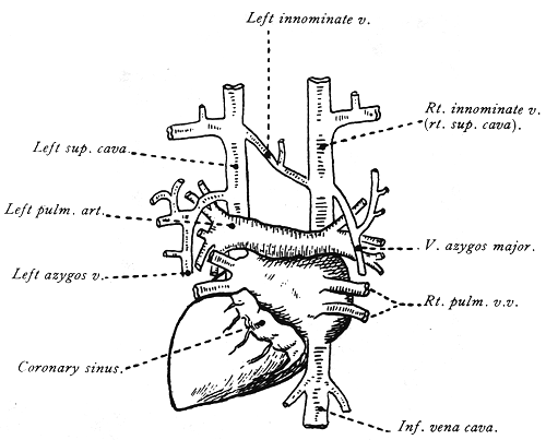 Image of persistent left superior vena cava