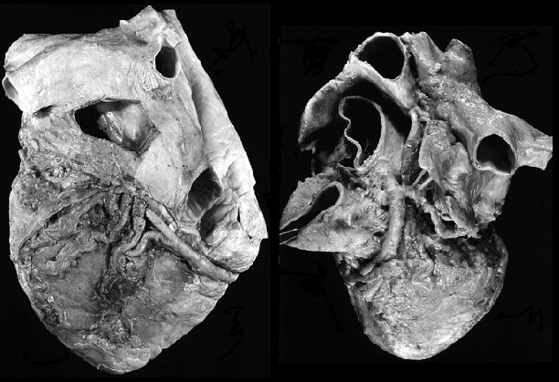 Image of absence of coronary sinus