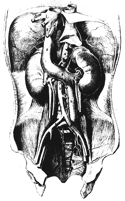 Image of transposition of inferior vena cava to left side without transposition of viscera