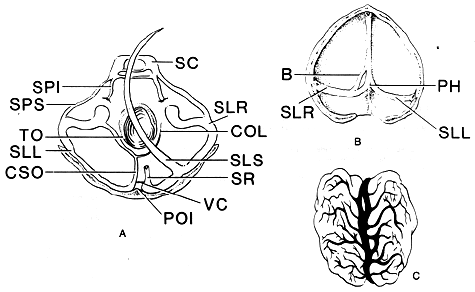 Image of absence of dural sinuses