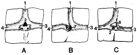 Image of various types of confluens of sinuses