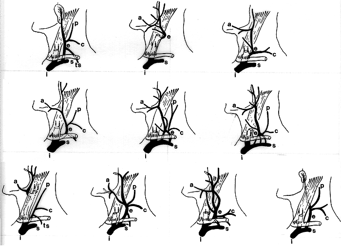 Image of external jugular vein