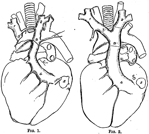 Image of persistence of both ducts of cuvier