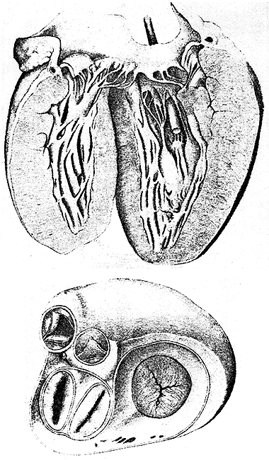 Image of doubled left atrioventricular valve