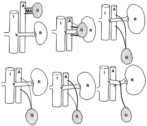 Image of gonadal artery variations