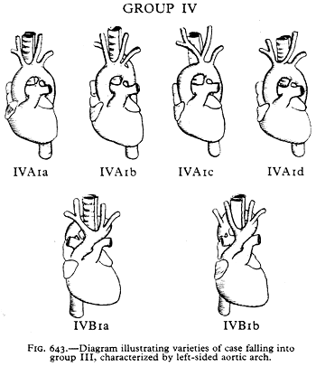 Image of double aortic arch