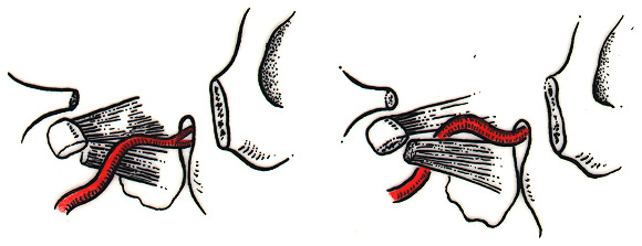 Image of maxillary artery relationship with lateral pterygoid muscle