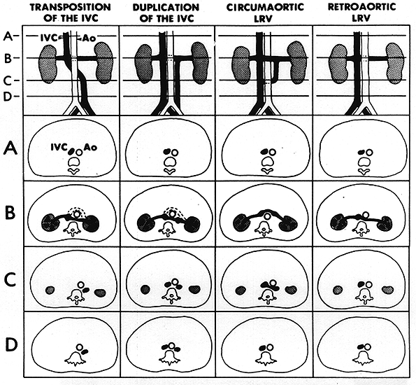 Image of evaluation of variations of inferior vena cava and left renal vein