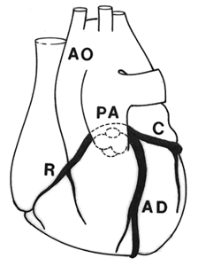 Image of single left coronary artery originating from pulmonary artery