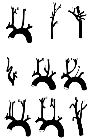 Image of unusual origin of external and internal carotids