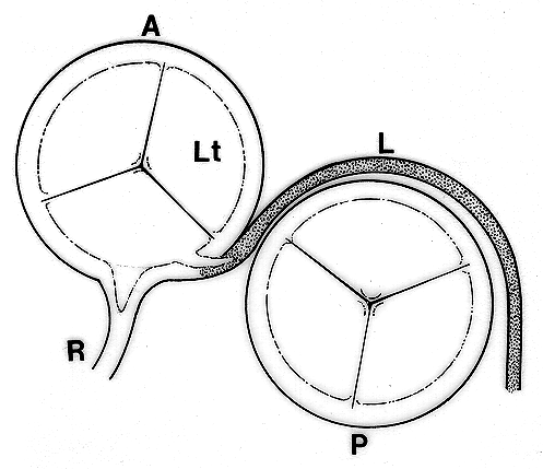 Image of unusual aortic origin of left coronary artery