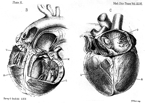 Image of transposition of great vessels