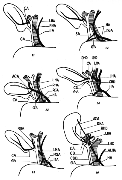 Image of hepatic pedicle