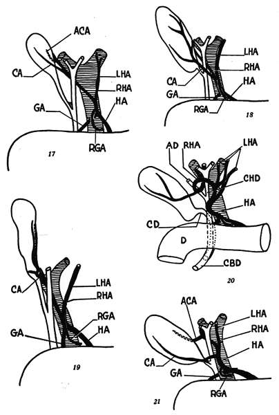 Image of hepatic pedicle