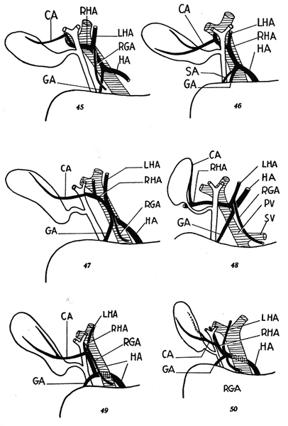 Image of hepatic pedicle