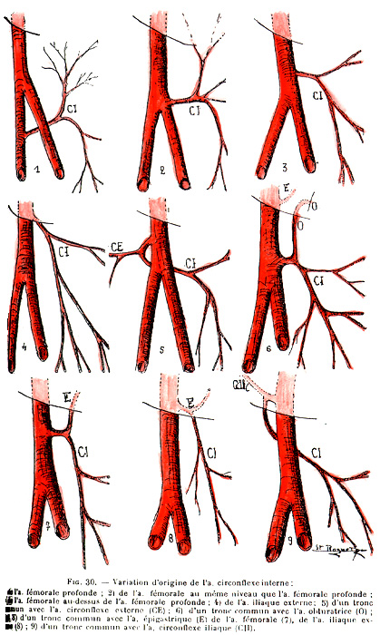 Image of variations of the origin of the medial circumflex