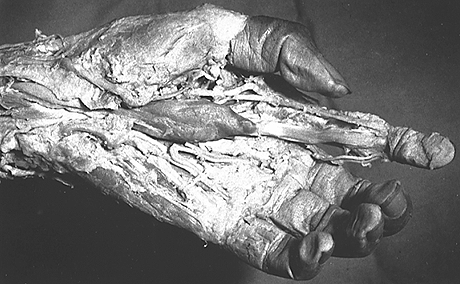 Image of flexor digitorum superficialis accessorius