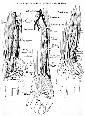 Image of varieties of palmaris longus