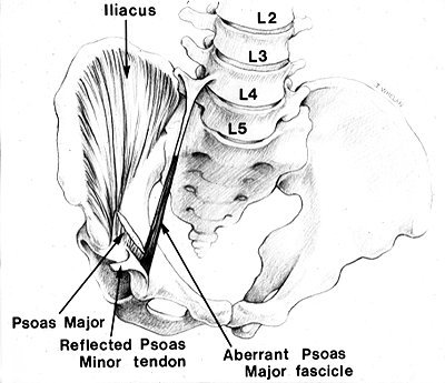 Image of psoas major accessorius