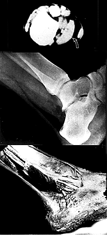 Image of flexor accessorius longus