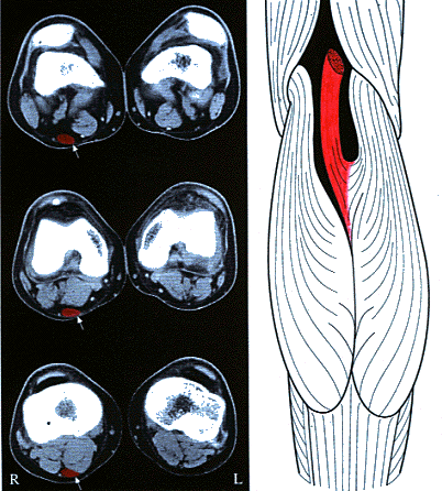 Image of gastrocnemius tertius