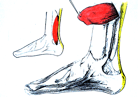 Image of accessory soleus