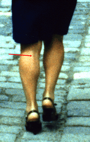 Image of gastrocnemius tertius in a living subject