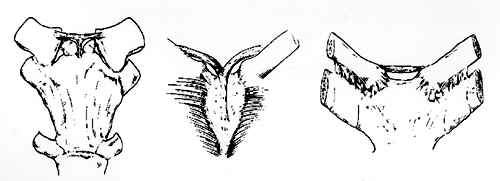 Image of varieties of sterno-clavicularis muscles