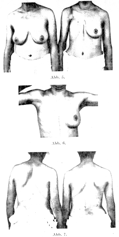 Unilateral absence of a mammary gland in sisters