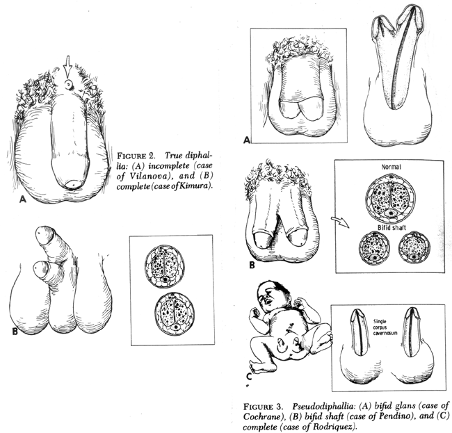 Diphallia and Pseudodiphallia