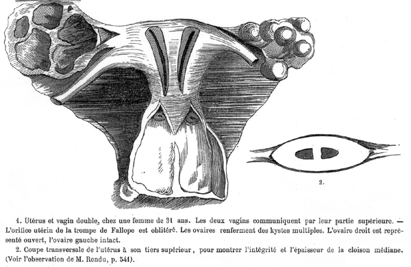 Double uterus and vagina