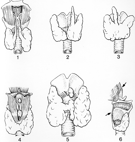 Thyroid Gland Variations