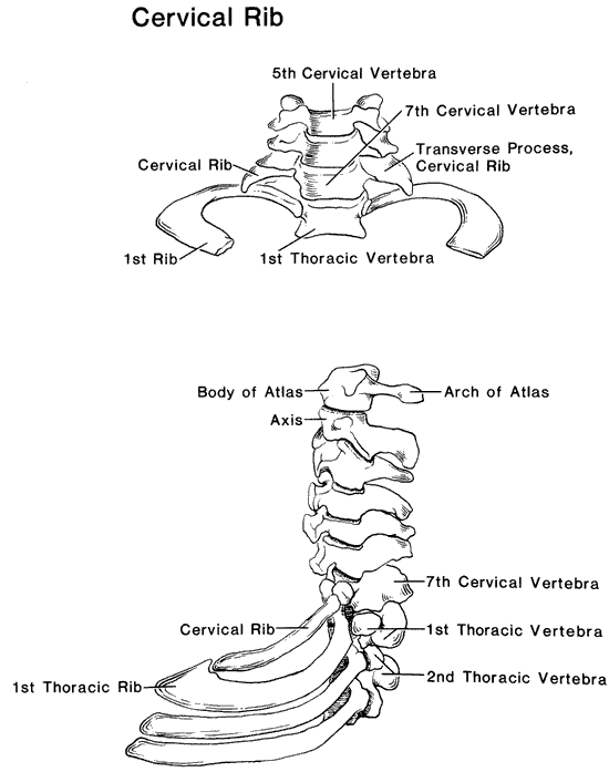 Cervical Rib