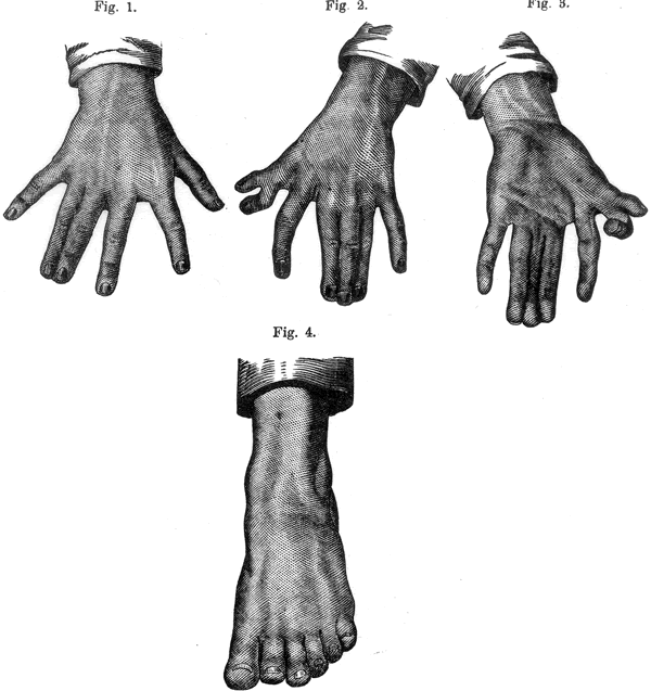 Polydactylie