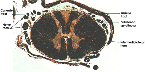 Plate 17.319 Spinal Cord Lesion