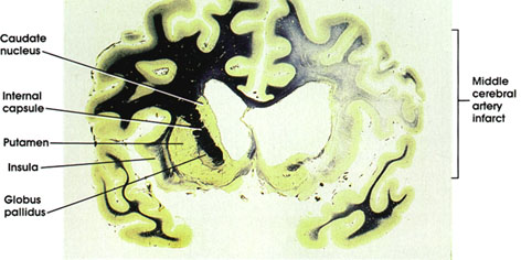 Plate 17.350 Middle Cerebral Artery Infarct