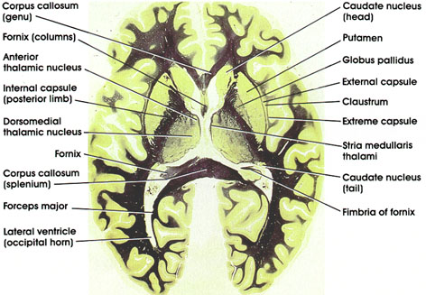 Plate 17.354 Thalamus and Basal Ganglia