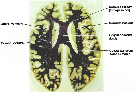 Plate 17.357 Caudate Nucleus