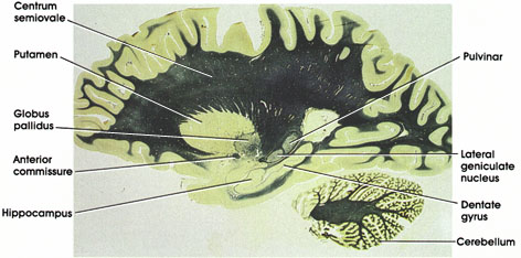 Plate 17.359 Section Through Lenticular Nucleus