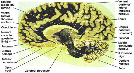 Plate 17.362 Section through Cerebral Penduncle