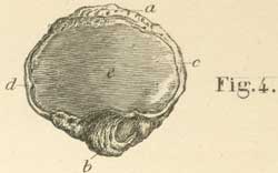 The left patellar inner or posterior surface.